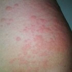 Netelroos: een allergische huidreactie