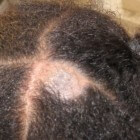 Tinea capitis (hoofdschimmel): Schimmelinfectie op hoofdhuid