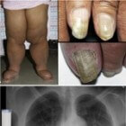 Gele nagel-syndroom: Symptomen aan benen (zwelling) & nagels