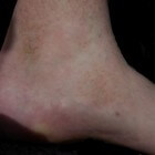 Capillaritis: Huidaandoening met roodbruine vlekken