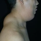 Ziekte van Madelung: Vetafzettingen in nek en schouders