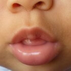 Opgezwollen lip: oorzaken van gezwollen bovenlip en onderlip