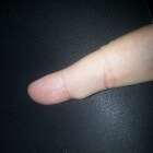 Bultje op vinger: oorzaken knobbel of knobbeltjes op vinger