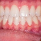 Ontstoken tandvlees: Oorzaken, symptomen en behandelingen