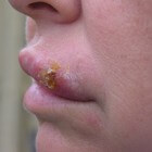 Korstje op de lip of een droog plekje: oorzaak & behandeling