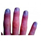 vingerafdruk Uitputting Vermindering Blauwe vingers en handen: oorzaken van blauw-paarse vingers | Mens en  Gezondheid: Aandoeningen