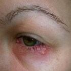 Herpes simplex virus in het oog: symptomen en behandeling