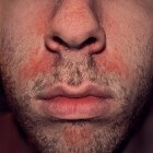 negatief Reis Verbazing Droge rode schilferige huid rond neus: oorzaken en symptomen | Mens en  Gezondheid: Aandoeningen