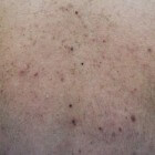Kleine Rode Stipjes Op Huid: Oorzaak Van Puntbloedinkjes | Mens En  Gezondheid: Aandoeningen