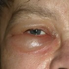 Dikke ogen: oorzaken van zwelling en vocht onder de ogen