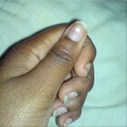 Leukonychie: Witte nagels (witte lijntjes, vlekken, puntjes)