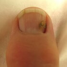 Gemiddeld blok rand Zwarte nagel: oorzaak van zwarte vlekken onder de nagel | Mens en  Gezondheid: Aandoeningen