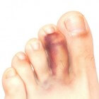 Gebroken teen of tenen: symptomen, oorzaak en behandeling
