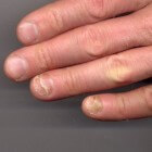 Onycholyse (nagelloslating): Scheiding nagels van nagelbed
