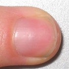 Gespleten nagels: oorzaken gebarsten of splijtende nagels | Mens en