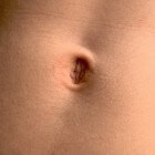 Bloedende navel: oorzaken van klein beetje bloed uit navel