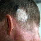 Poliose: Haaraandoening met witte haren, soms door ziekte
