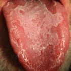 Schilferige tong: Oorzaken van schilferend tonggebied