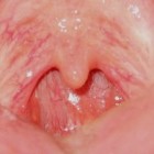 Huig is dik en ontstoken (uvulitis): symptomen & behandeling