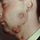 Tinea barbae: Schimmelinfectie aan baardstreek van mannen