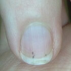 Splinterbloeding: symptomen onder de nagel en behandeling