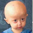 Progeria: Versnelde lichamelijke veroudering