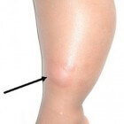Gezwollen benen: oorzaken en behandeling van vocht in been