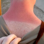 Zonnebrand: Rode, pijnlijke huid door blootstelling aan zon