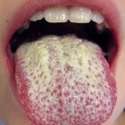 Mondspruw: Schimmelinfectie aan mond met witte vlekken