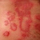 Pijnlijke huiduitslag: Oorzaken van uitslag op huid met pijn