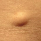 Lipoom: vetbultje in romp, nek, schouders, oksels of armen