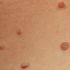 Fibromen (skin tags): Huidgezwelletjes op steeltje