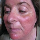 beweging Praten Oppervlakte Rood gezicht: oorzaken en behandeling rode huid in gezicht | Mens en  Gezondheid: Aandoeningen
