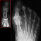 Hallux rigidus: Artrose aan gewricht grote teen met pijn