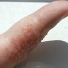 Schilferige vingers: symptomen, oorzaken & behandeling