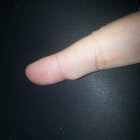 Bultje op vinger: Oorzaken van knobbels op vingers