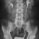 Intraveneuze pyelografie: Röntgenfoto's van urinewegstelsel