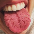 Kloofjestong: Tongafwijking met groeven of kloven in de tong