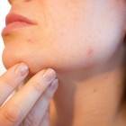 Puistjes op kin: Behandeling van acne op kingebied