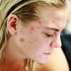 Steroïde acne: Puistjes door gebruik van corticosteroïden