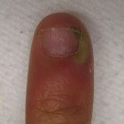 Pus onder de nagel: oorzaken van etterende nagelontsteking