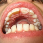 Afgebroken tand: oorzaken, behandeling, prognose & preventie