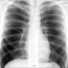 Röntgenfoto van borstkas (thoraxfoto): Procedure onderzoek