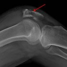 Gebroken knie: symptomen en behandeling gebroken knieschijf