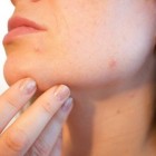 Soorten acne  van jeugdpuistjes tot beroepsacne