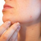Onzuivere huid: oorzaken, huismiddeltjes en behandeling
