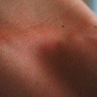 Gevoelige huid (huidgevoeligheid): Oorzaken en behandeling