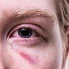 Stekende, scherpe, schietende oogpijn: Oorzaken