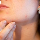 Informatie over acne