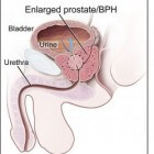 Vergrote prostaat of BPH (Benigne Prostaat Hyperplasie)